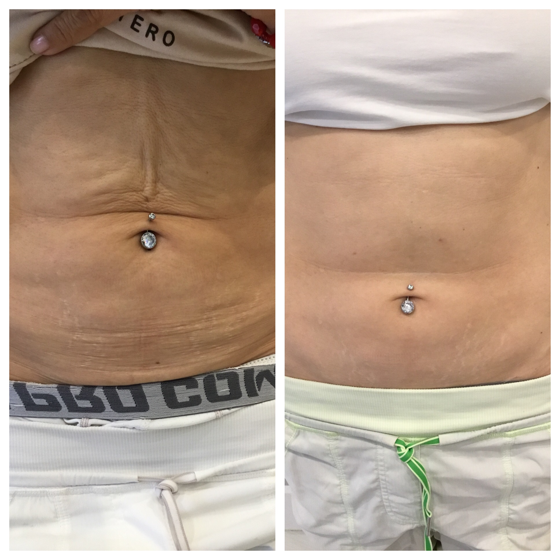 PDO Threading in Palm Beach Gardens, FL NonSurgical Skin Tightening