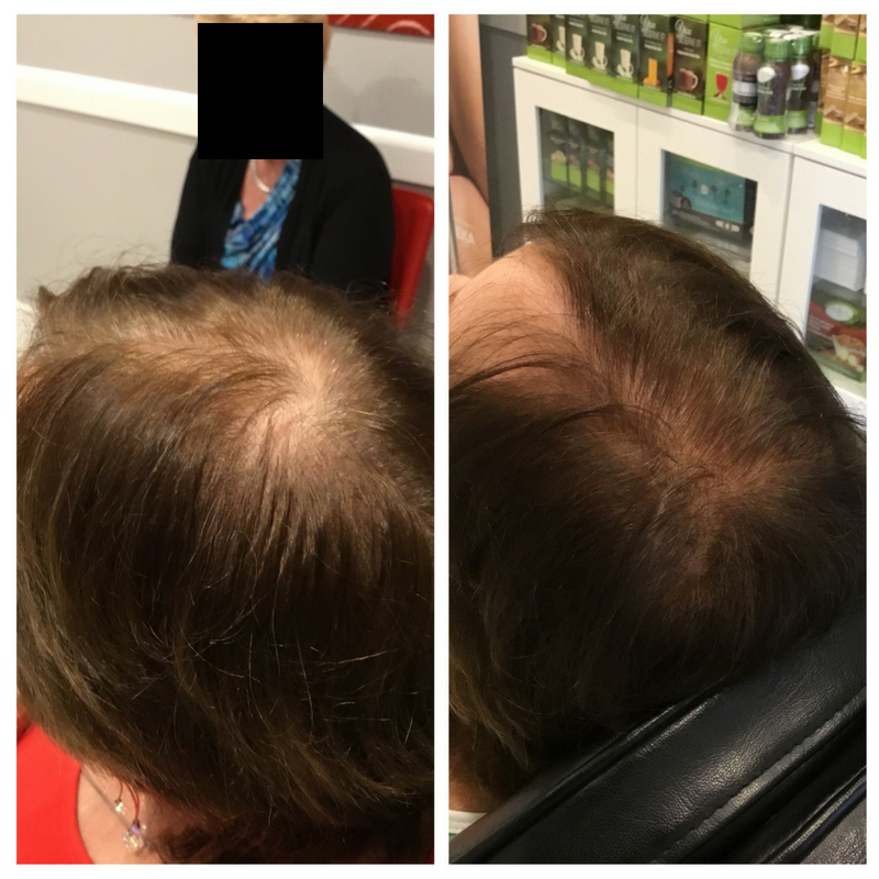 PRP for Hair Loss Before & After