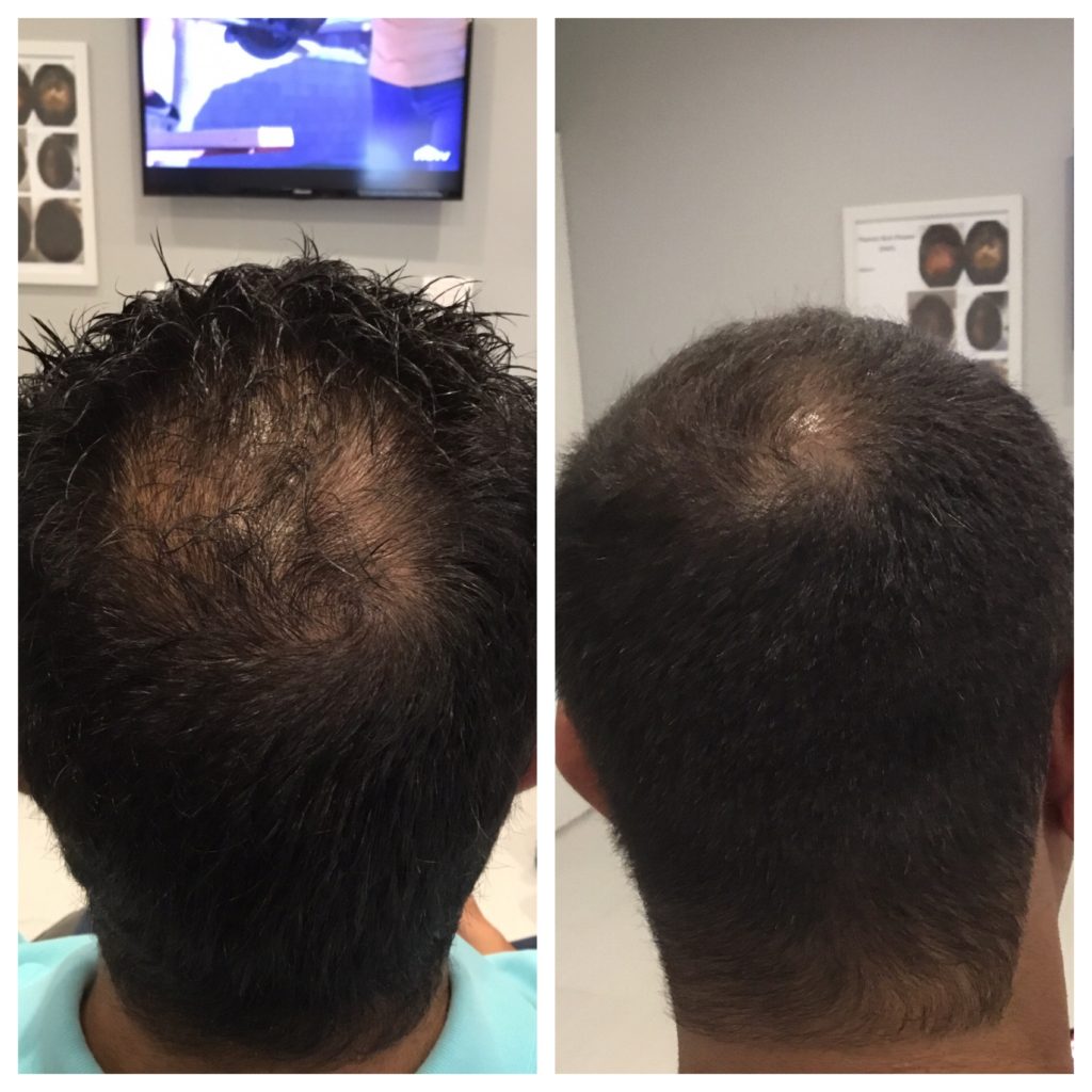 PRP for Hair Loss Before & After