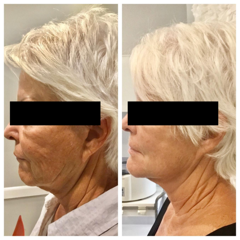 Before And Afters Youthful Balance Medical Center In Palm Beach Gardens