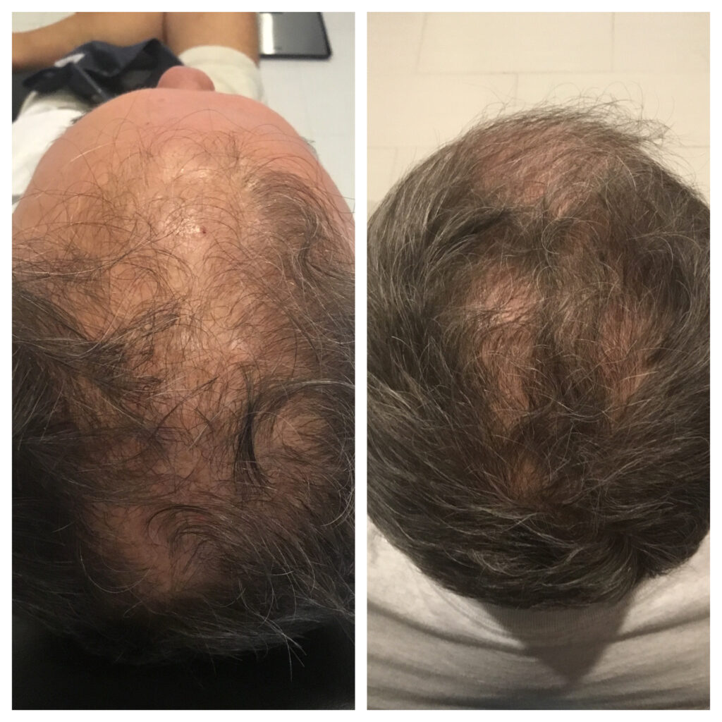 PRP Before & After for Hair Loss